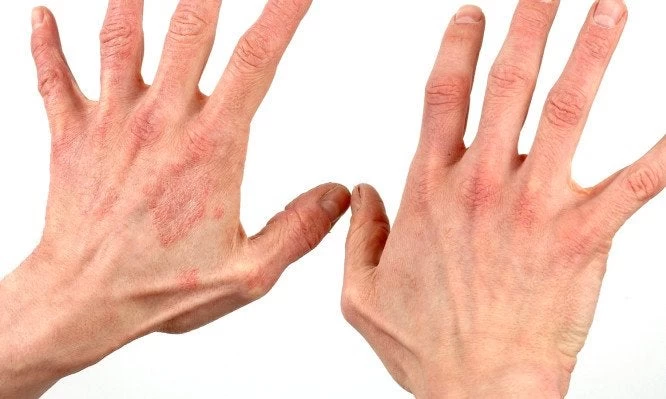 Δερματίτιδα: Συμπτώματα και τρόποι αντιμετώπισης – Δείτε το βίντεο